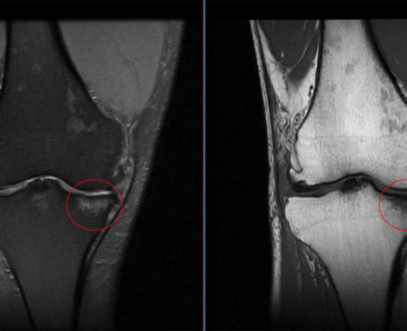 Knee Pain and Bone Bruising - Oklahoma