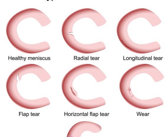 Meniscus Tear Knee Pain