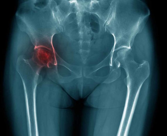 Avascular Necrosis of hip -Osteonecrosis of Hip