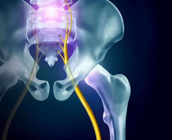 Hip Sciatica - Sciatic Nerve Hip Pain