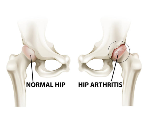 Hip Arthritis Specialists in Oklahoma