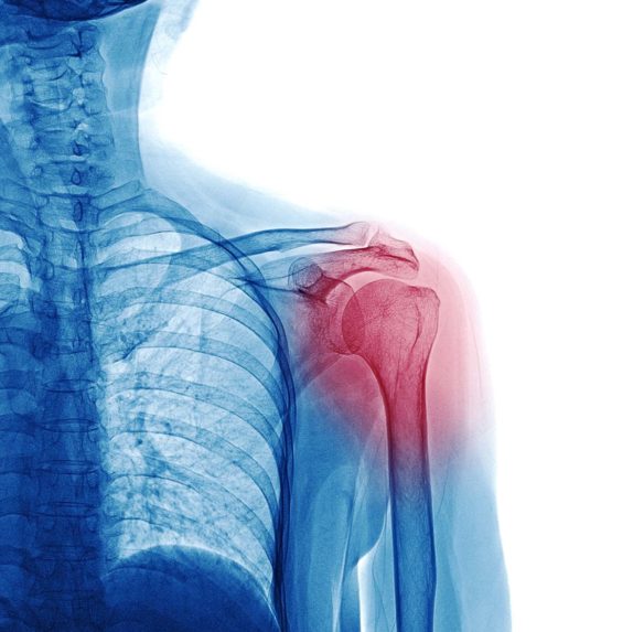 Shoulder Pain Structures - Shoulder Pain Anatomy