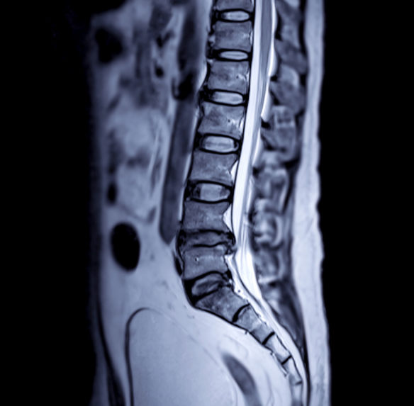Spine Pain MRI - Degenerative Discs in Oklahoma
