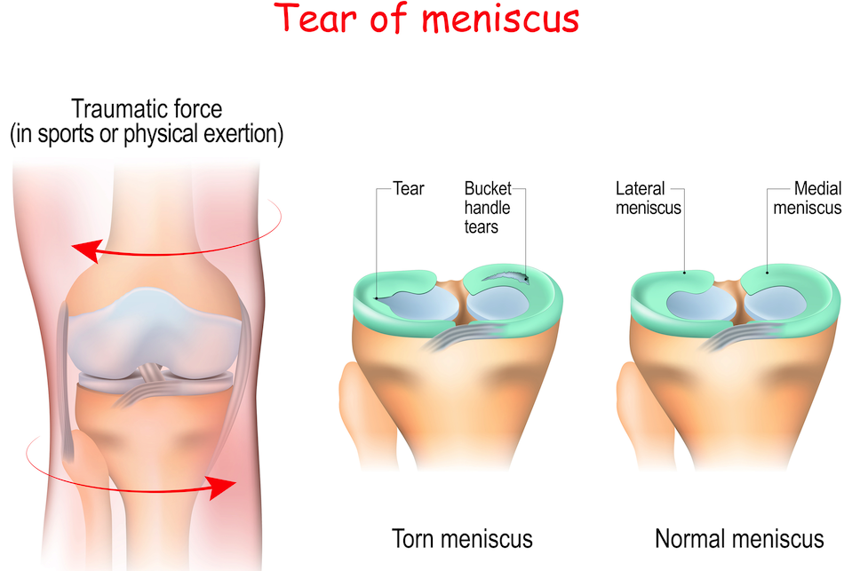 Tear of meniscus illustration